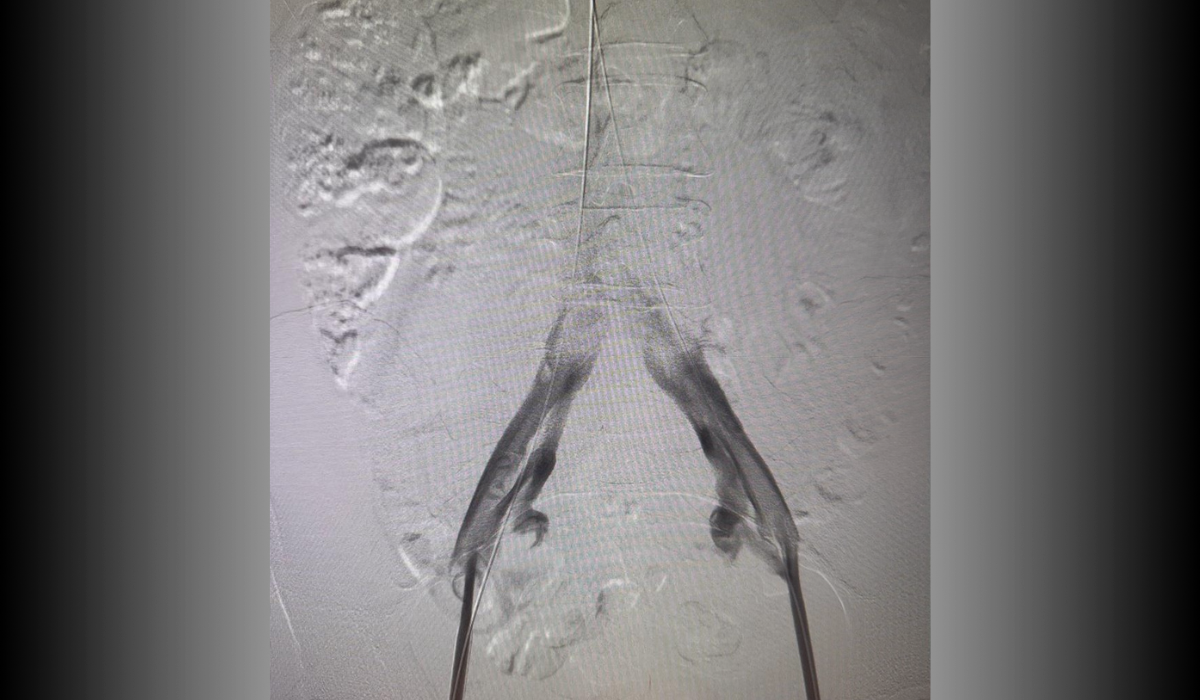 Pre-treatment: Bilateral iliac vein occlusion