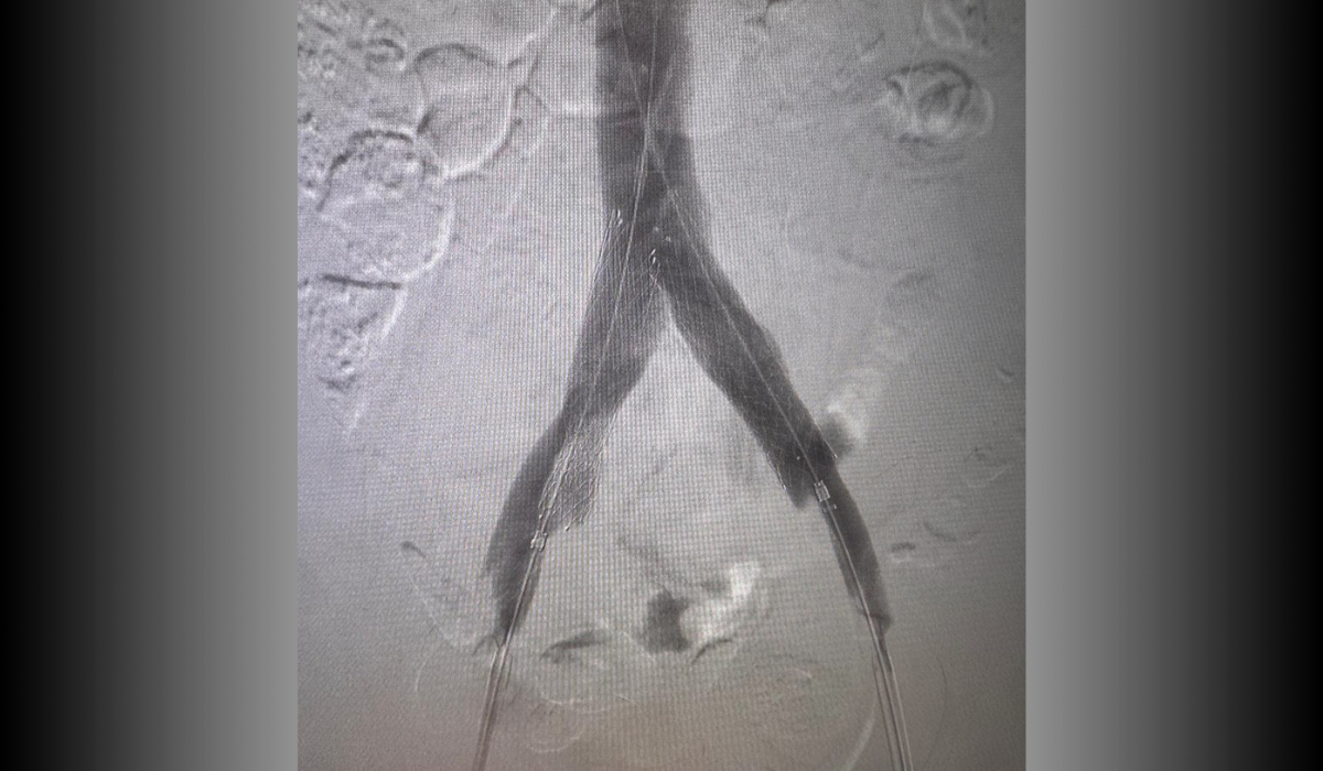 Post-treatment: Endovascular reconstruction with stent placement