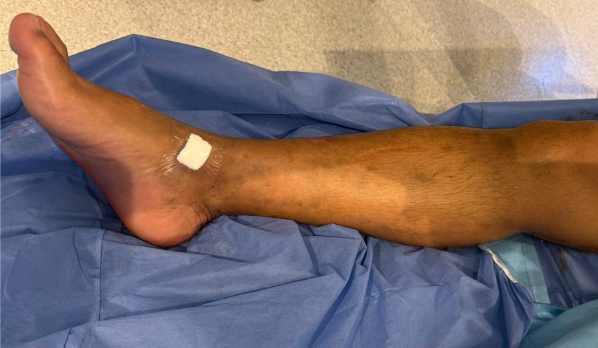 VenaSeal: current approach